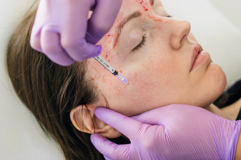 پی آر پی چیست و به چه کسانی توصیه میشود؟ - سل تک بیوژن | Celltech Biogenesis
