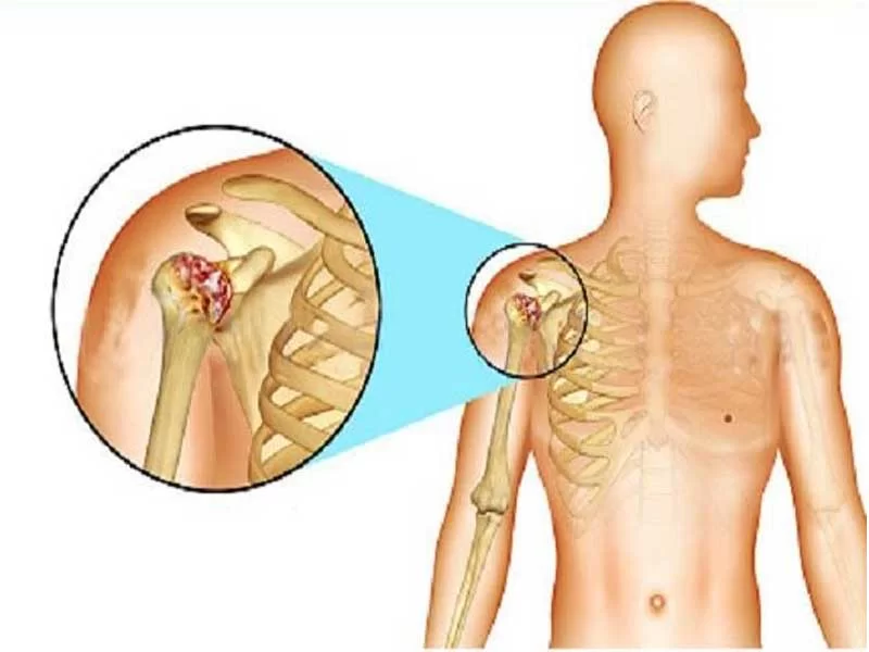 درمان آرتروز شانه