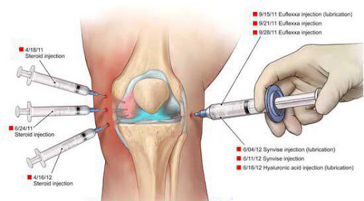 درمان مفاصل با تزریق پی آر پی