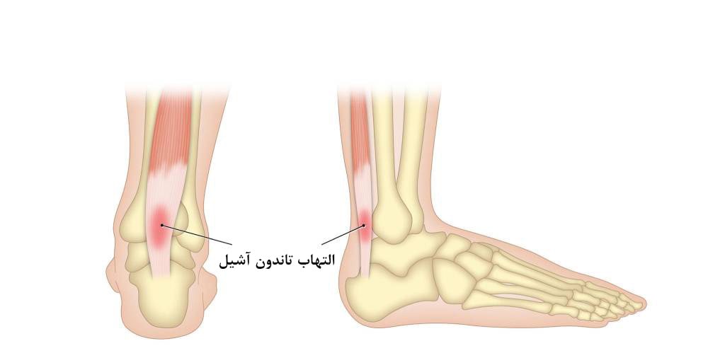 درمان تاندونیت آشیل با پی آرپی