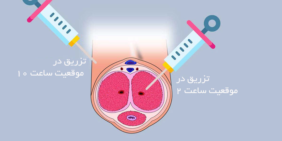 درمان اختلال نعوظ با PRP پی آر پی