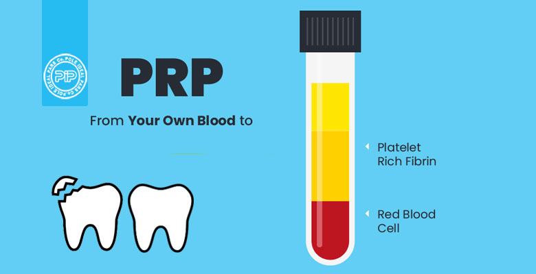 مزایای فرآیند PRP در دندانپزشکی