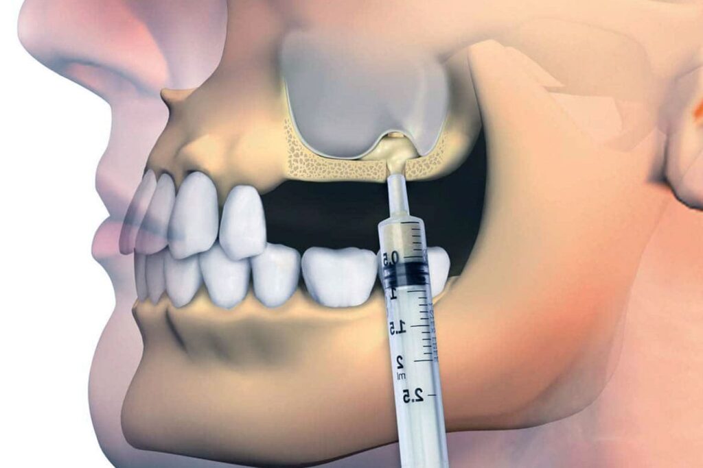 جراحی لیفت سینوس