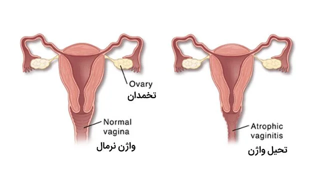 آتروفی واژن