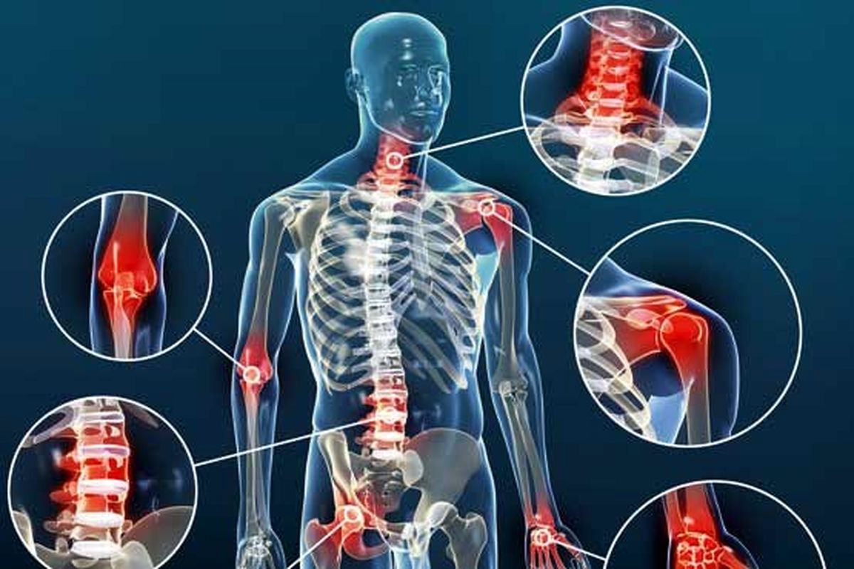 انواع آرتروز و علائم آنها - سل تک بیوژن | Celltech Biogenesis