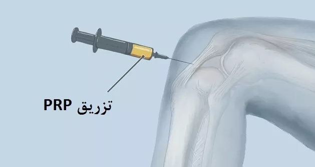 اثرات PRP در تسریع ترمیم تاندون ها