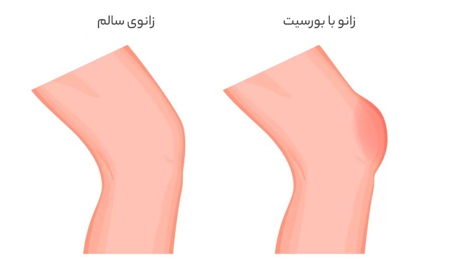 بیماری بورسیت