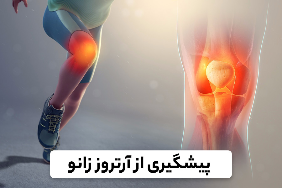 راه های پیشگیری از آرتروز زانو