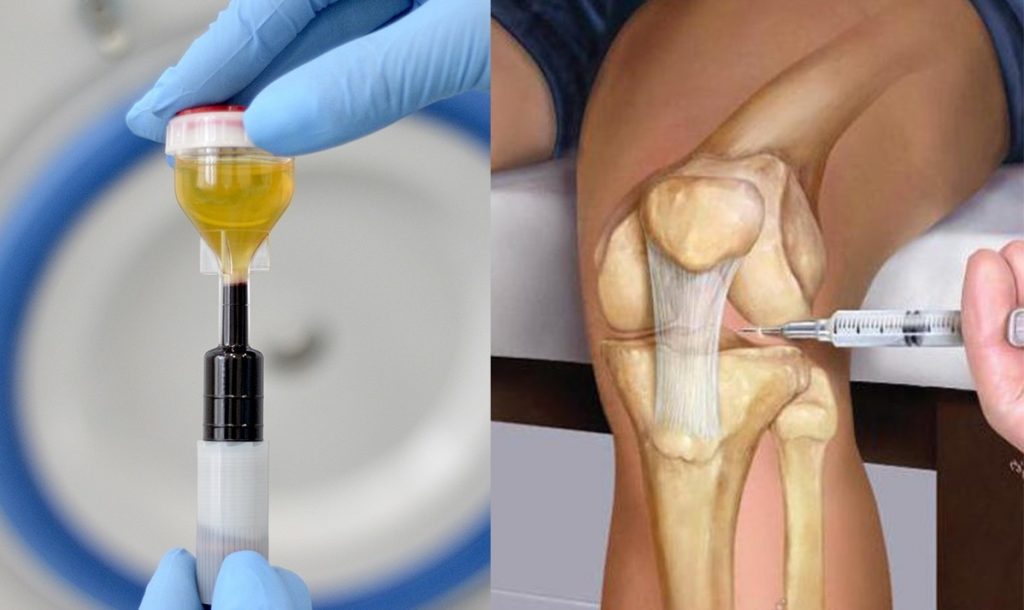 کاربردهای PRP در درمان پارگی‌های منیسک