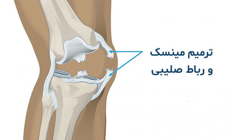 نقش PRP در ترمیم رباط صلیبی قدامی