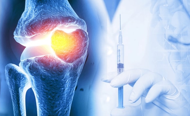 تاثیر PRP در کاهش درد و التهاب مفاصل