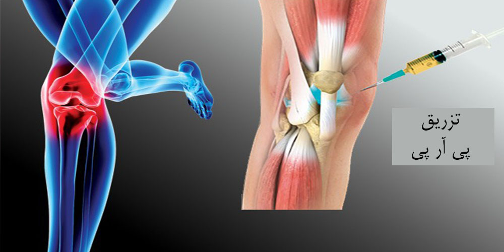 اثرات PRP در تسریع ترمیم تاندون ها