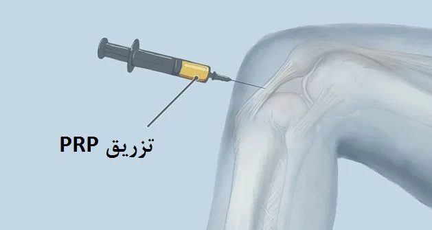 PRP در درمان همارتروز