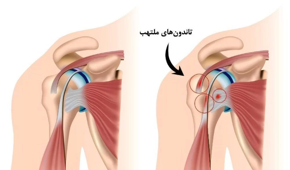 تزریق پی آر پی شانه