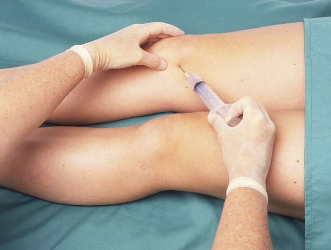 اثرات PRP در بیماران مبتلا به آرتروز زانو و کمر