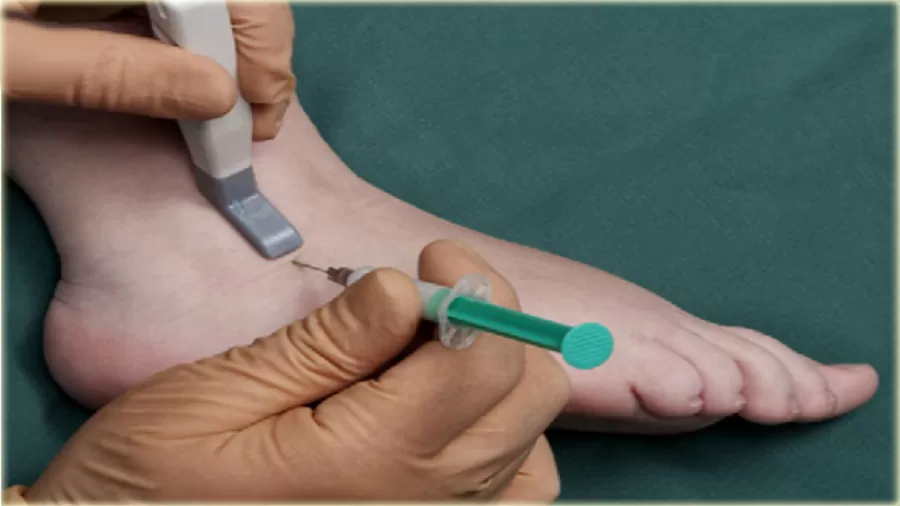 PRP در درمان آرتروز مچ پا و آرنج