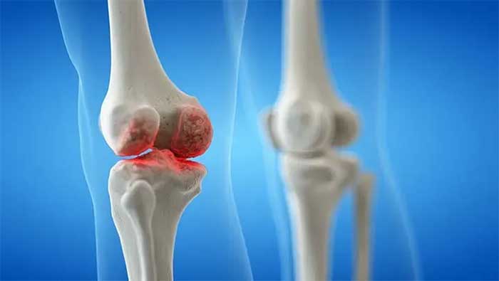 اثرات PRP در درمان استئومیلیت‌ها