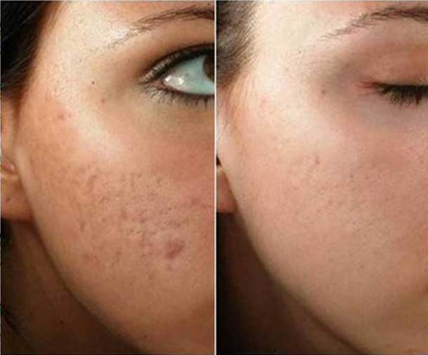 PRP برای بهبود بافت اسکار و جای جوش