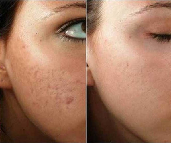 مقایسه PRP با MINI-PRP و L-PRP در زیبایی پوست