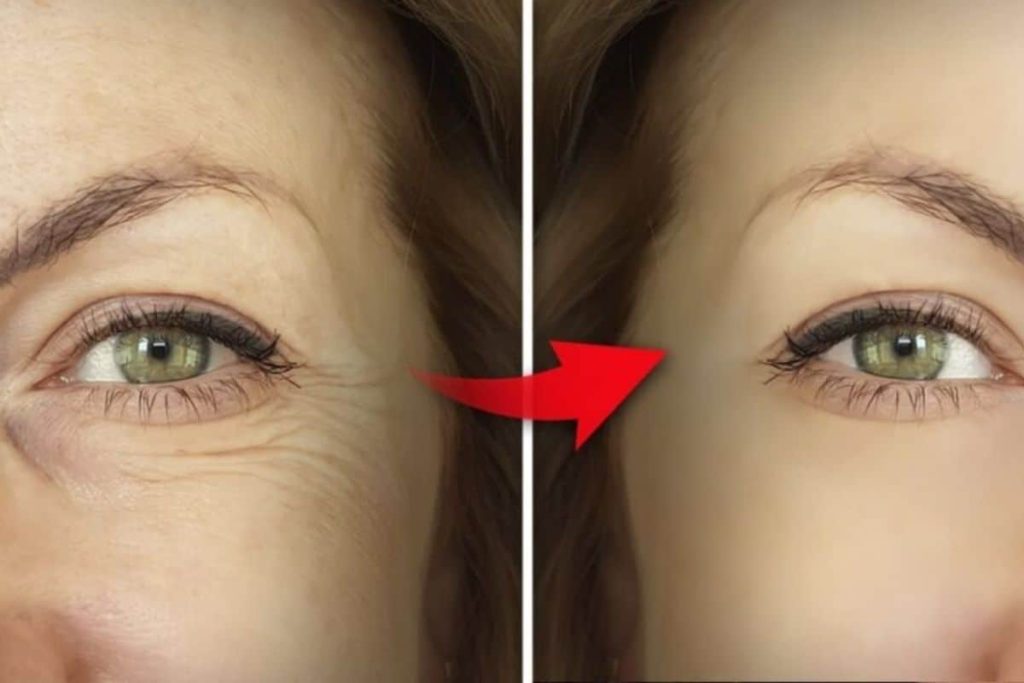 تاثیر PRP بر کاهش پف و خطوط تیرگی پوست دور چشم