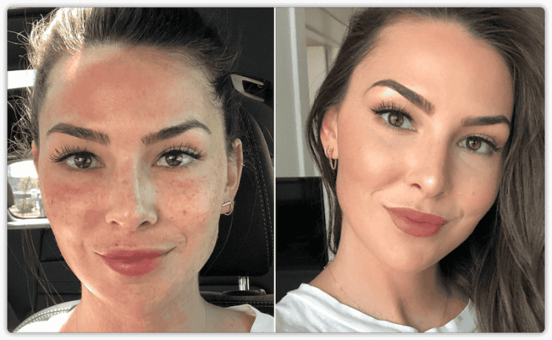 آیا PRP در درمان لکههای پوستی و هایپرپیگمنتیشن موثر است؟