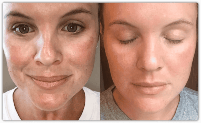 آیا PRP در درمان لکههای پوستی و هایپرپیگمنتیشن موثر است؟