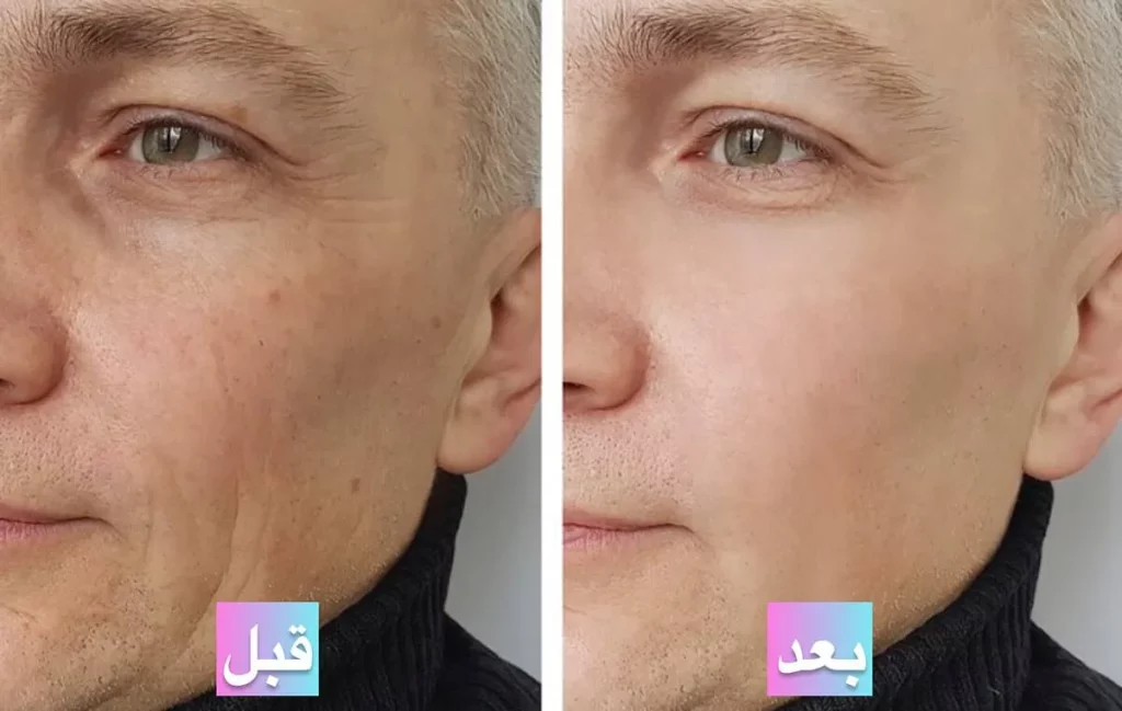 بررسی اثر PRP بر روشنشدن و یکدستی رنگ پوست