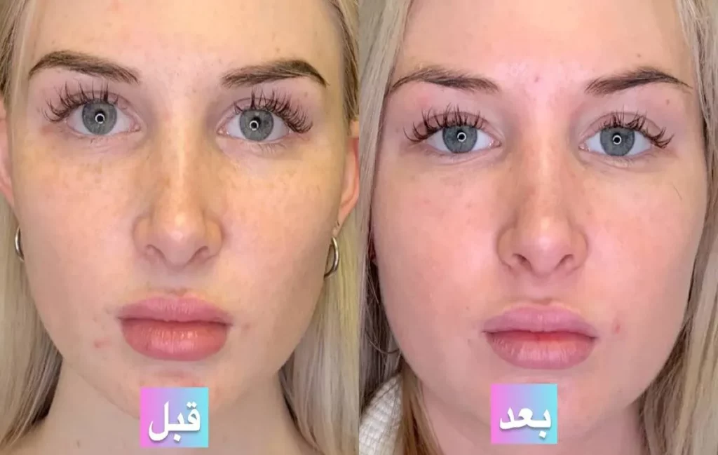 بررسی اثر PRP بر روشنشدن و یکدستی رنگ پوست