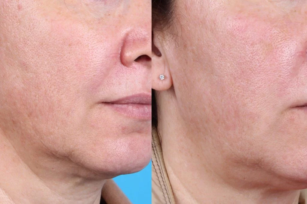 اثر PRP بر روشنشدن و یکدستی رنگ پوست