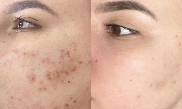 PRP برای بهبود بافت اسکار و جای جوش