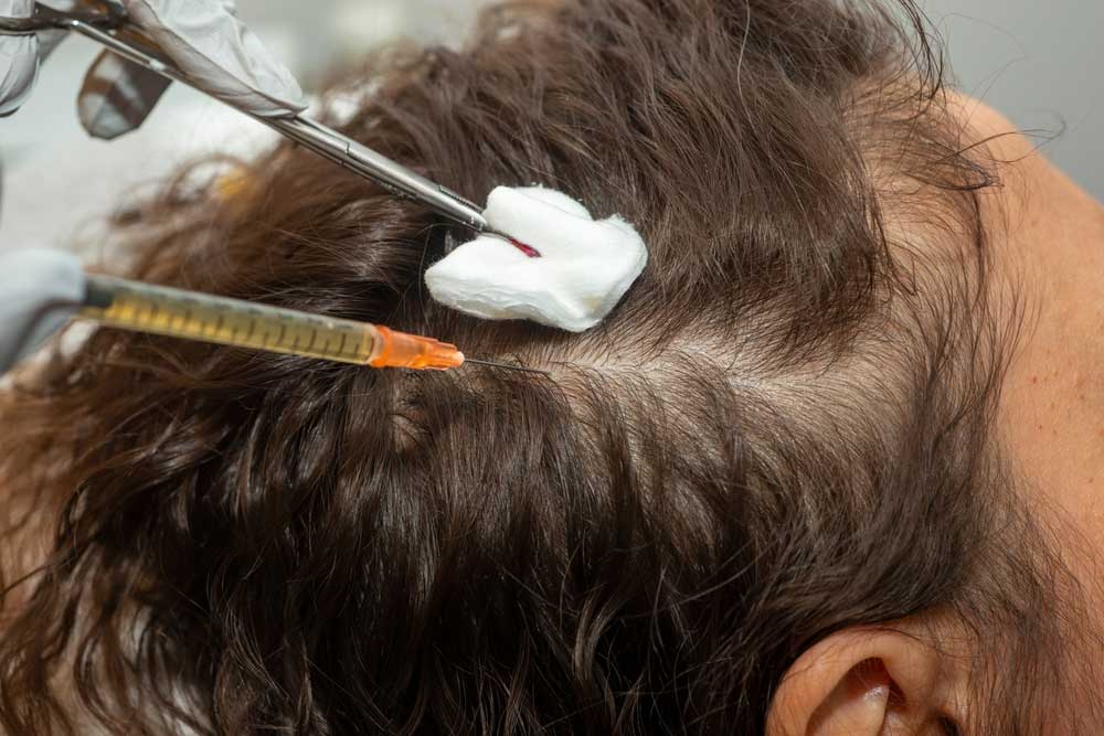 مقایسه تفاوت اگزوزوم و پی آر پی در حوزه زیبایی