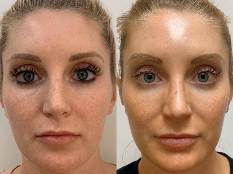 آیا PRP در درمان لکههای پوستی و هایپرپیگمنتیشن موثر است؟