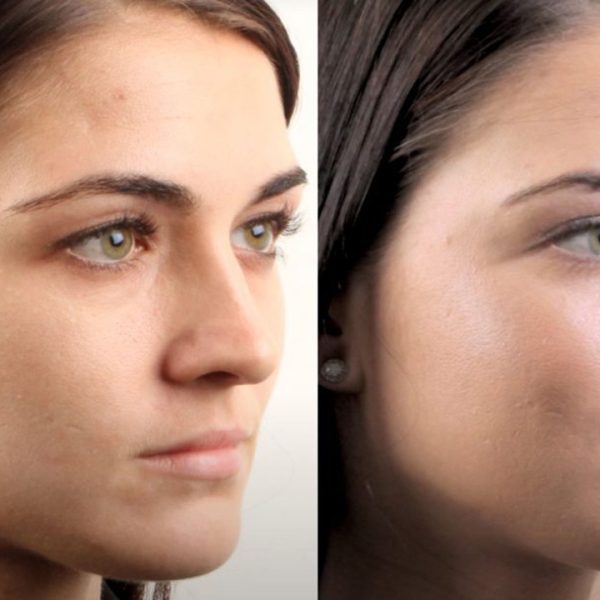 اثر PRP بر الاستیسیته و تراکم پوست صورت