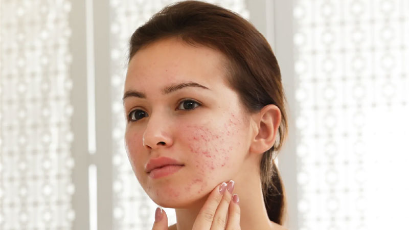 تاثیر PRP برای پوست‌های چرب و منافذ باز