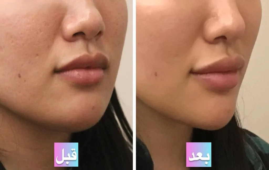 جوانسازی لب و اطراف دهان با پی آر پی