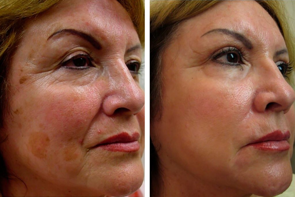 جوانسازی لب و اطراف دهان با پی آر پی