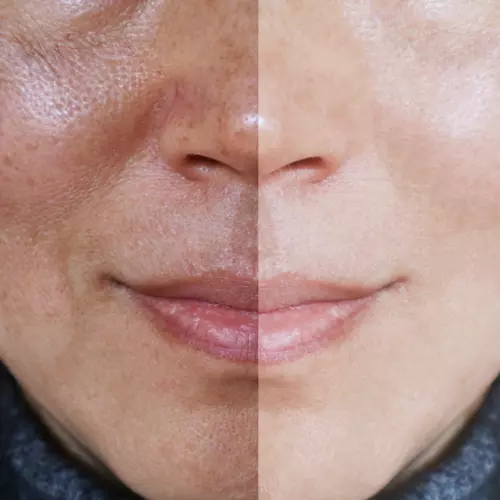 تاثیر PRP برای پوست‌های چرب و منافذ باز