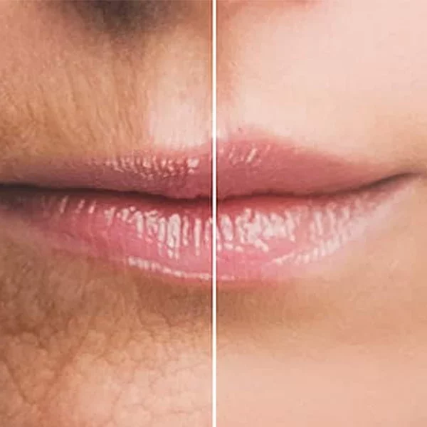 جوانسازی لب و اطراف دهان با پی آر پی