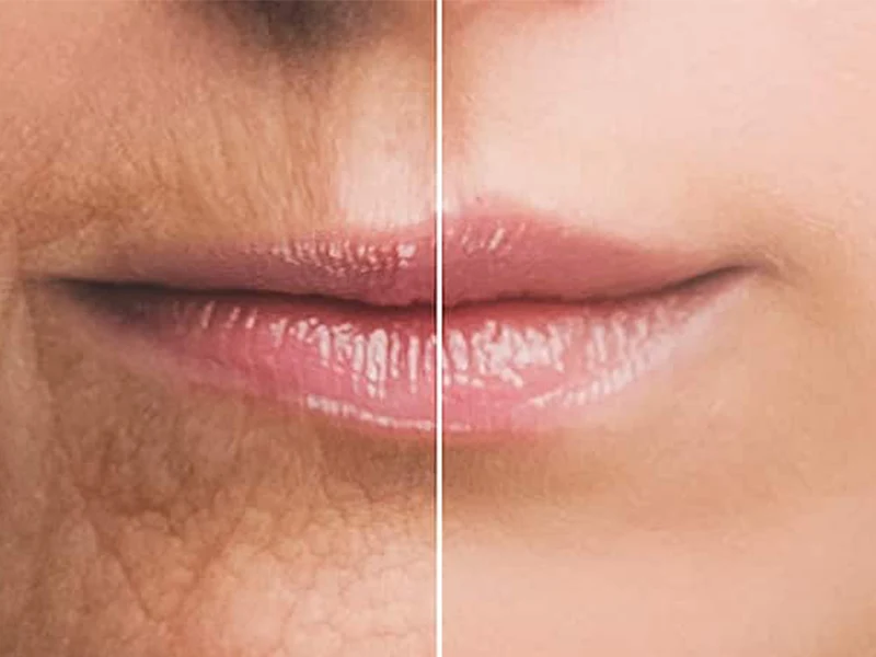 جوانسازی لب و اطراف دهان با پی آر پی