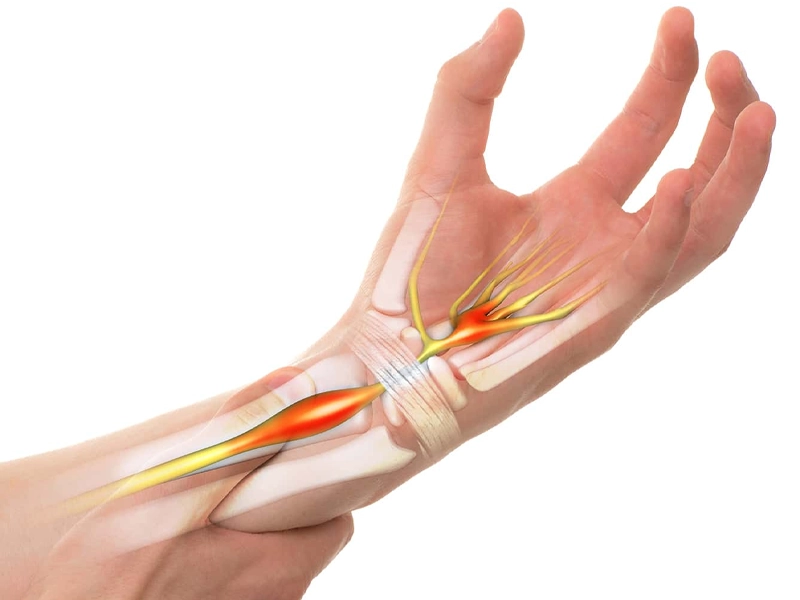 بررسی روش درمان PRP برای سندرم تونل کارپال