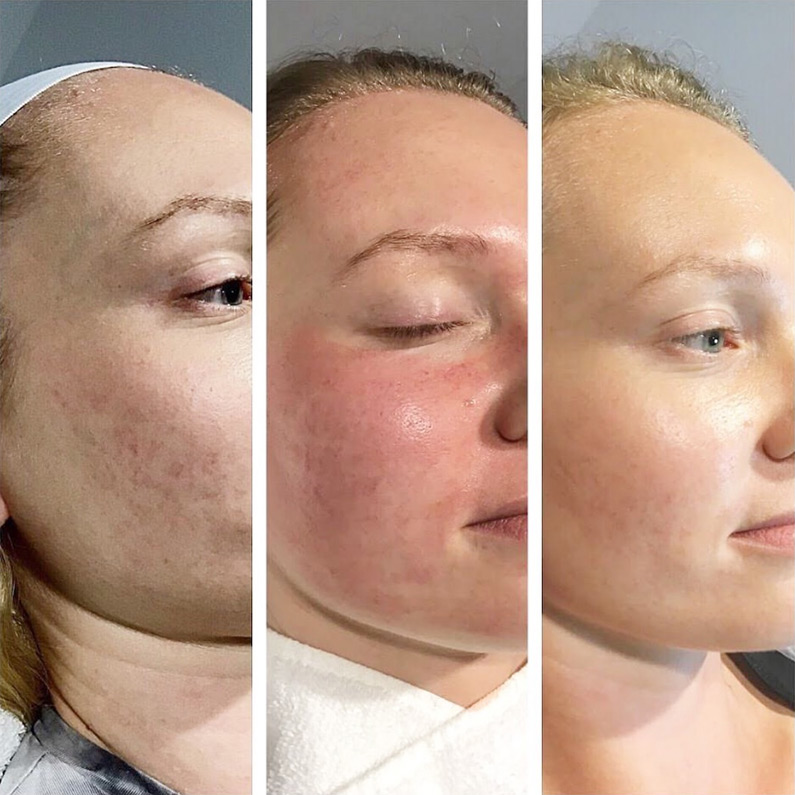 اثر PRP بر الاستیسیته و تراکم پوست صورت